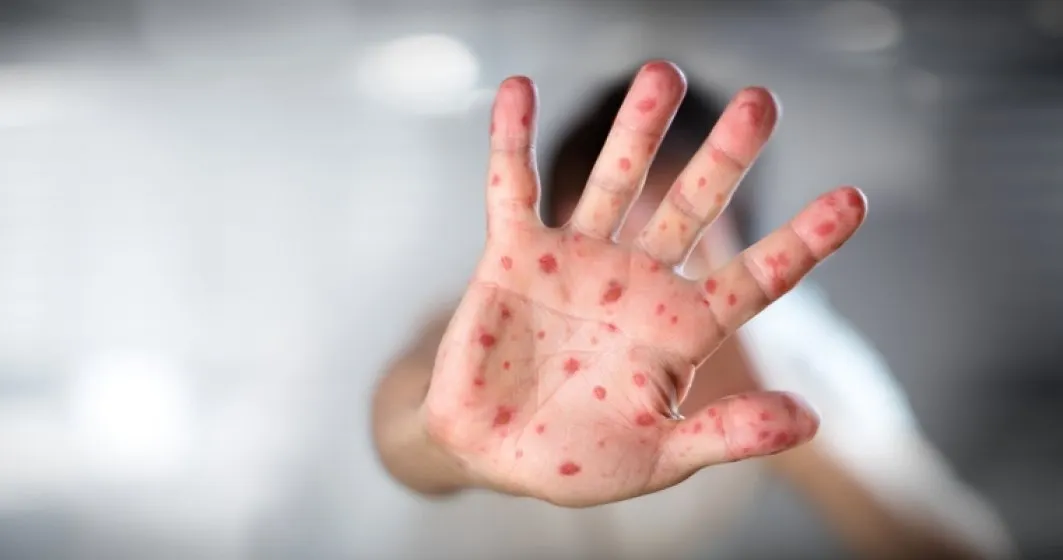 Bebeluș nevaccinat, decedat din cauza rujeolei