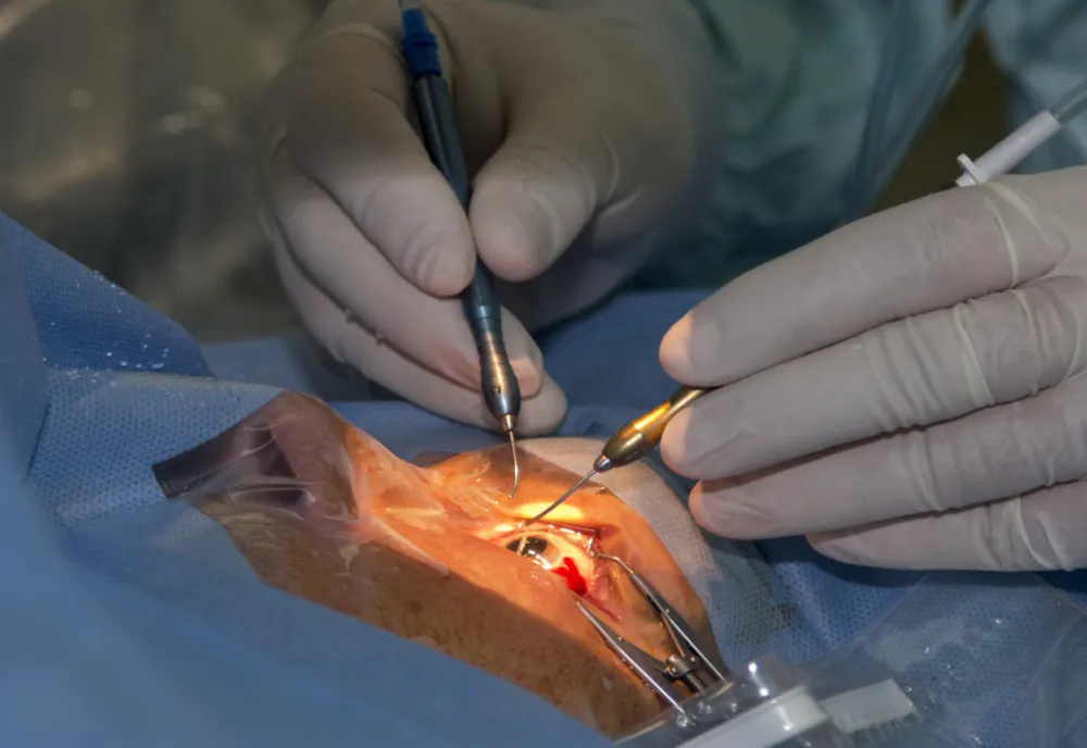 Transplant de cornee la Spitalul „Sf. Spiridon" Iași