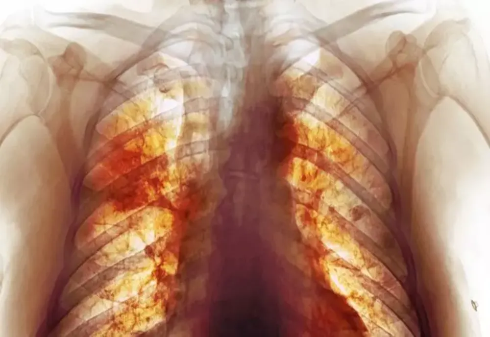Adevărata dimensiune a dezastrului Covid. Cea mai detaliată radiografie dezvăluie cum arată, de fapt, plămânii după infectare - FOTO