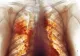 Adevărata dimensiune a dezastrului Covid. Cea mai detaliată radiografie dezvăluie cum arată, de fapt, plămânii după infectare - FOTO
