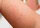 Fetiţă cu scarlatină, internată la Infecţioase