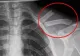 Otrava asta îţi distruge oasele! O bei în fiecare zi fără să știi cât de toxică este pentru organism