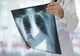Alertă epidemiologică: Focar de tuberculoză la o grădiniţă din Iași